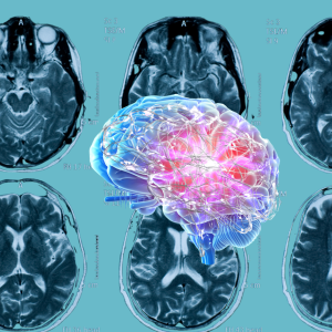 A.I. brain atrophy
